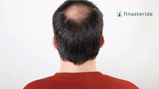 Het effect en de ervaringen van finasteride